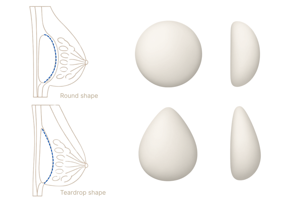 Brustimplantate rund oder tropfenförmig
