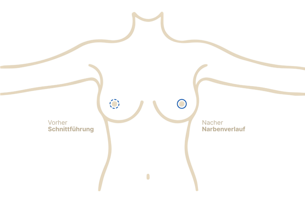 Bruststraffung mit Benelli-Methode (O-Schnitt)