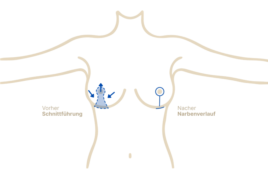 Bruststraffung mit T-Schnitt